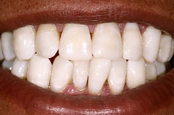 After Teeth Whitening